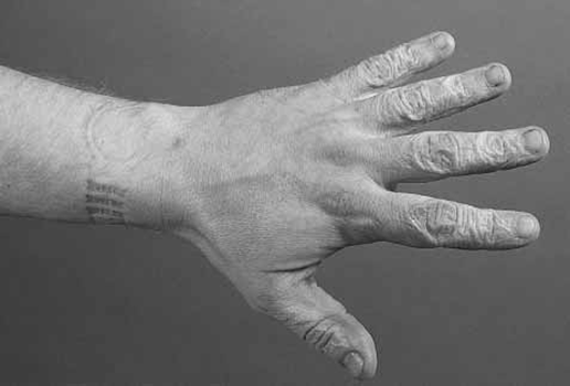 Acute painful swelling and excessive wrinkling of the skin of the hand, after exposure to N-methyl-2-pyrrolidone (NMP)