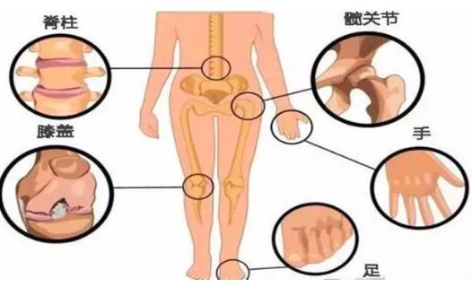 岩藻多糖复配绿壳贻贝防治糖尿病性骨关节炎