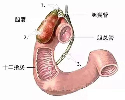 胆囊炎