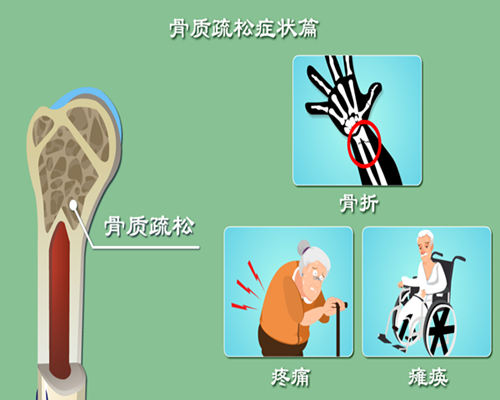 唑来膦酸：老年骨质疏松的缓解方案