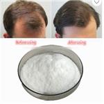 minoxidil