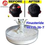 Finasteride